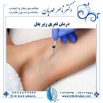 درمان قطعی تعریق زیر بغل