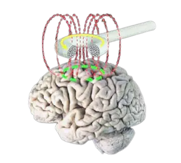 درمان سکته مغزی با rtms