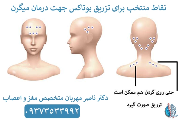 درمان میگرن با تزریق بوتاکس