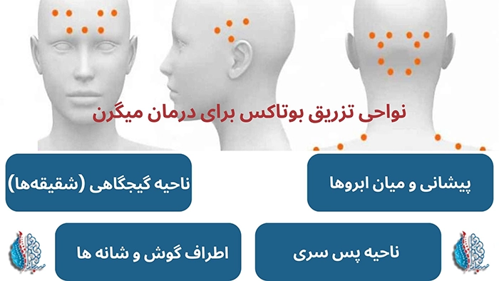 نواحی تزریق بوتاکس برای درمان میگرن