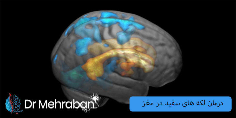 درمان-لکه-های-سفید-در-مغز